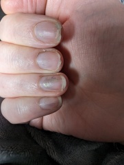 Had biabs removed, nails are a mess!