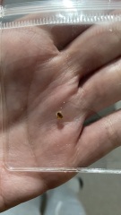 Is this a kidney stone? Picture of urine and suspected stone included.