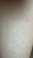 Very itchy spots - bother gp?