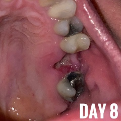 Tooth extraction still hurting & swollen on day 9?