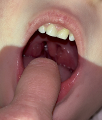 Enlarged tonsils and/or adenoids