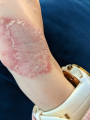 Contact Dermatitis? Please help!