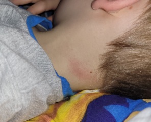 What's this on DS's neck?
