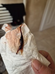 Is this is miscarriage or common discharge? Any help appreciated