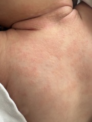 Heat rash or eczema? Or something else?
