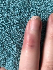 Finger injury / broken ?!