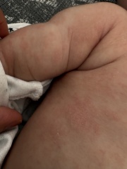 Heat rash or eczema? Or something else?