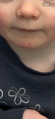 Toddler same spot on face for 8 weeks