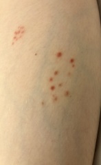 What on earth is this rash? Should I keep off school?