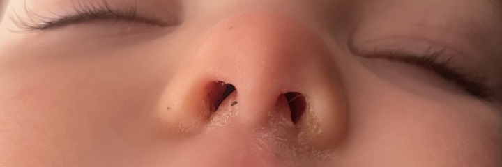 17 month olds nose, really worried