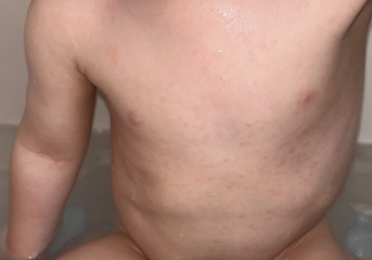 Rash on toddler?