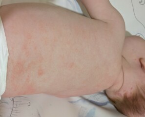 Baby eczema? Photos attached