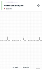 Any DRs/nurses? ECG question?