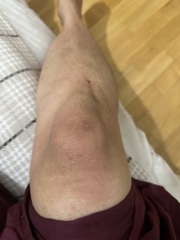 Spots/all over rash