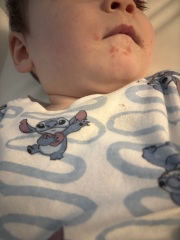 Rash on baby - allergy?