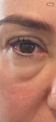 Help! My eyes! Lash lift gone wrong
