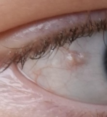 What is this in my DD eye? Please advice?