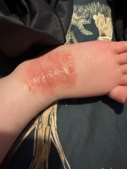 Rash/blisters on 17 month old *pics*