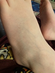 Strange rash on feet