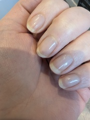 Had biabs removed, nails are a mess!