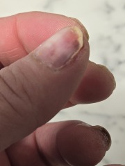 Nail damage