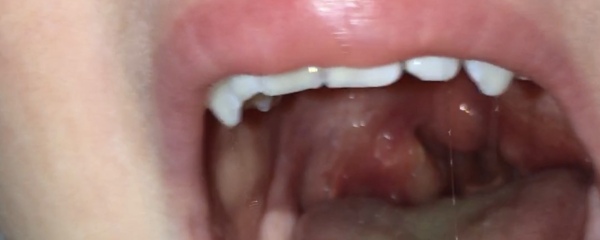 Daughter’s throat - opinions please