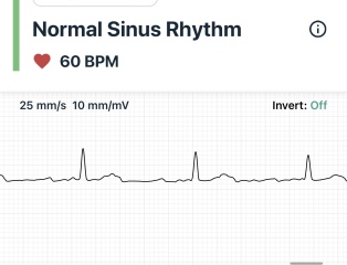 Any DRs/nurses? ECG question?