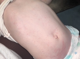 Rash on toddler?