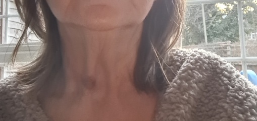 Anyone had Botox or treatment for 'turkey neck'?