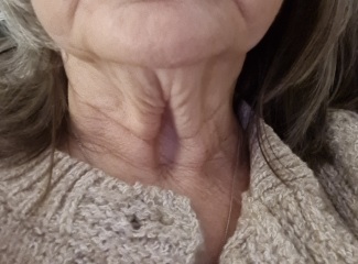 Anyone had Botox or treatment for 'turkey neck'?