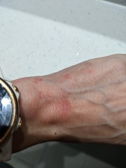 Contact Dermatitis? Please help!