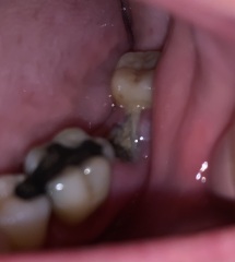 Any Dentist? Dry Socket *[Content warning: opening post contains images of extracted tooth/gums]