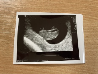 9 week scan reassurance?