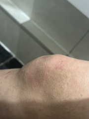 Spots/all over rash