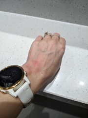 Contact Dermatitis? Please help!