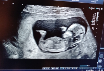 OMG! It's triplets!!!