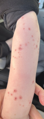 Is this chicken pox?