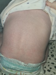 Rash on 10 month old
