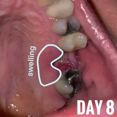 Tooth extraction still hurting & swollen on day 9?
