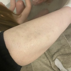 Unexplained bruising - clear blood test