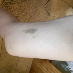 Unexplained bruising - clear blood test