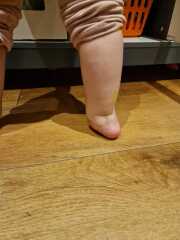 Will my 2 year old ever walk?