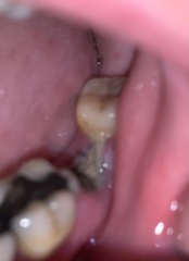 Any Dentist? Dry Socket *[Content warning: opening post contains images of extracted tooth/gums]