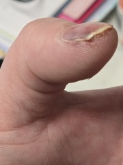 Nail damage