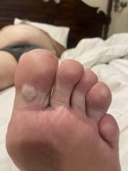 What is this on my foot?