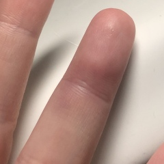 Finger injury / broken ?!