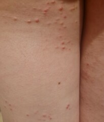What is this rash?