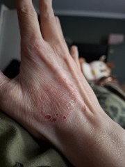 Contact Dermatitis? Please help!