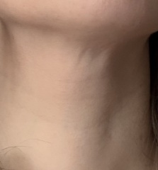 Sagging neck already, at 37?!