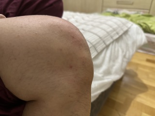 Spots/all over rash